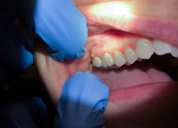 Best Emergency Tooth Extraction in Glyndon, MN